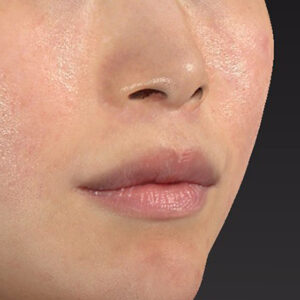 新宿ラクル美容外科クリニック　山本厚志　「人中短縮術（リップリフト）＋口角挙上（スマイルリップ）」　手術後１２ヶ月目　３月２４日