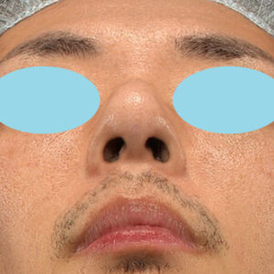 「ワシ鼻修正（ハンプ切除）」　新宿ラクル美容外科クリニック　４０代男性　手術後１ヶ月目　１月１１日