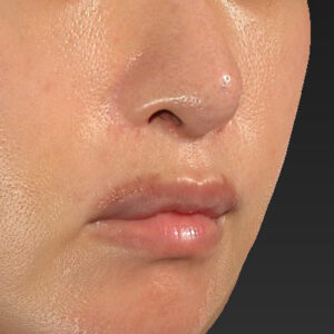新宿ラクル美容外科クリニック　山本厚志　「外側人中短縮術（上口唇挙上術）修正 + 口角挙上（スマイルリフト）修正」　手術後１ヶ月目　１月２２日
