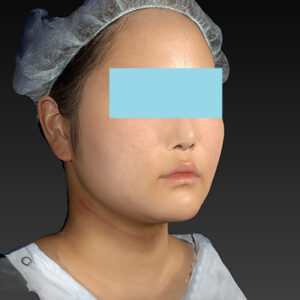 新宿ラクル美容外科クリニック　山本厚志　「ライポライフ脂肪吸引（メーラーファット+ジョールファット+アゴ下）」　手術後１ヶ月目　１月２７日