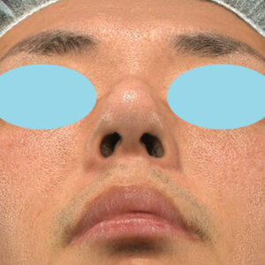 「ワシ鼻修正（ハンプ切除）」　新宿ラクル美容外科クリニック　４０代男性　手術後２ヶ月目　１月１１日