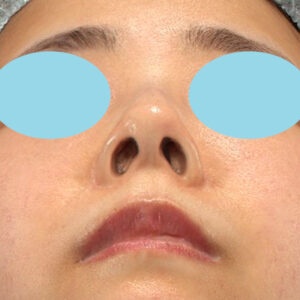 「鼻孔縁下降術」　新宿ラクル美容外科クリニック　山本厚志　３０代女性　手術後２ヶ月目　１月２３日