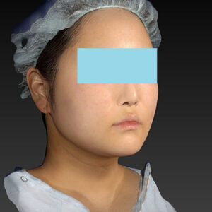 新宿ラクル美容外科クリニック　山本厚志　「ライポライフ脂肪吸引（メーラーファット+ジョールファット+アゴ下）」　手術後２ヶ月目　１月２７日