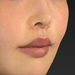 新宿ラクル美容外科クリニック　山本厚志　「人中短縮術（リップリフト）＋口角挙上（スマイルリップ）」　手術後３ヶ月目　４月２４日