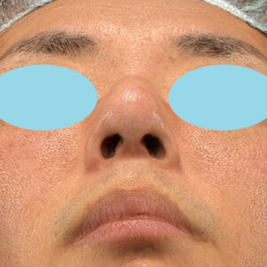 「ワシ鼻修正（ハンプ切除）」　新宿ラクル美容外科クリニック　４０代男性　手術後３ヶ月目　２月１０日