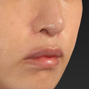 新宿ラクル美容外科クリニック　山本厚志　「外側人中短縮術（上口唇挙上術）修正 + 口角挙上（スマイルリフト）修正」　手術後３ヶ月目　２月１３日
