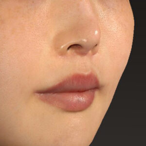 新宿ラクル美容外科クリニック　山本厚志　「人中短縮術（リップリフト）＋口角挙上（スマイルリップ）」　手術後６ヶ月目　３月２６日