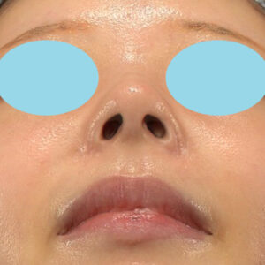 新宿ラクル美容外科クリニック　山本厚志　「小鼻縮小+α法」　手術後６ヶ月目　４月２日