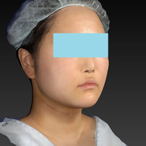 新宿ラクル美容外科クリニック　山本厚志　「ライポライフ脂肪吸引（メーラーファット+ジョールファット+アゴ下）」　手術後６ヶ月目　４月１５日