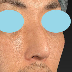 「ワシ鼻修正（ハンプ切除）」　新宿ラクル美容外科クリニック　４０代男性　手術前　１月１１日