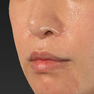 新宿ラクル美容外科クリニック　山本厚志　「外側人中短縮術（上口唇挙上術）修正 + 口角挙上（スマイルリフト）修正」　手術前　１月２２日