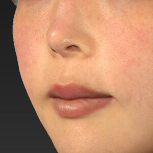 新宿ラクル美容外科クリニック　山本厚志　「人中短縮術（リップリフト）＋口角挙上（スマイルリップ）」　手術前　４月２４日