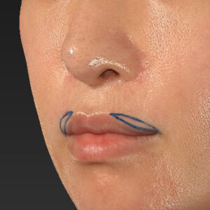 新宿ラクル美容外科クリニック　山本厚志　「外側人中短縮術（上口唇挙上術）修正 + 口角挙上（スマイルリフト）修正」　デザイン　１月２２日