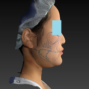 新宿ラクル美容外科クリニック　山本厚志　「ライポライフ脂肪吸引（メーラーファット+ジョールファット+アゴ下）」　デザイン　１月２７日