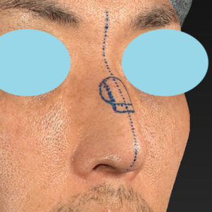 「ワシ鼻修正（ハンプ切除）」　新宿ラクル美容外科クリニック　４０代男性　デザイン　１月１１日