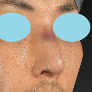 「ワシ鼻修正（ハンプ切除）」　新宿ラクル美容外科クリニック　４０代男性　手術直後　１月１１日