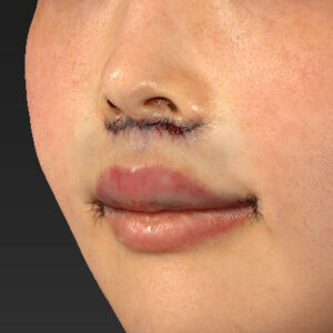 新宿ラクル美容外科クリニック　山本厚志　「人中短縮術（リップリフト）＋口角挙上（スマイルリップ）」　手術直後　１月２９日