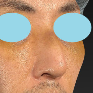 「ワシ鼻修正（ハンプ切除）」　新宿ラクル美容外科クリニック　４０代男性　手術後１週間目　１月１１日