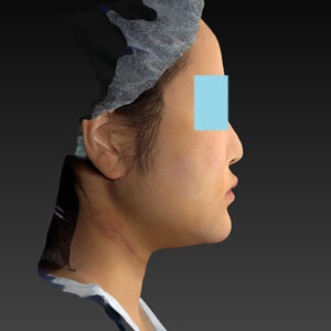 新宿ラクル美容外科クリニック　山本厚志　「ライポライフ脂肪吸引（メーラーファット+ジョールファット+アゴ下）」　手術後１週間目　１月２７日