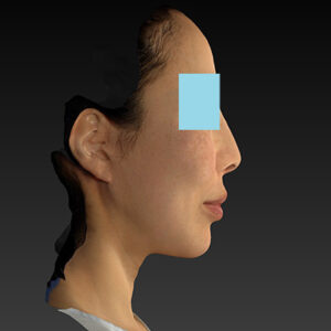 新宿ラクル美容外科クリニック　山本厚志　ナチュラルフェイスネックリフト　手術後１２ヶ月目　２月１５日