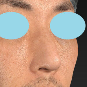 「ワシ鼻修正（ハンプ切除）」　新宿ラクル美容外科クリニック　４０代男性　手術後１ヶ月目　１月１１日