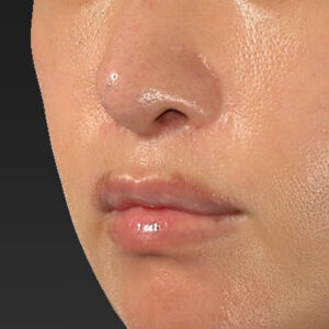 新宿ラクル美容外科クリニック　山本厚志　「外側人中短縮術（上口唇挙上術）修正 + 口角挙上（スマイルリフト）修正」　手術後１ヶ月目　１月２２日