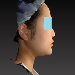 新宿ラクル美容外科クリニック　山本厚志　「ライポライフ脂肪吸引（メーラーファット+ジョールファット+アゴ下）」　手術後１ヶ月目　１月２７日