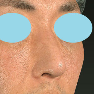 「ワシ鼻修正（ハンプ切除）」　新宿ラクル美容外科クリニック　４０代男性　手術後２ヶ月目　１月１１日