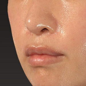 新宿ラクル美容外科クリニック　山本厚志　「外側人中短縮術（上口唇挙上術）修正 + 口角挙上（スマイルリフト）修正」　手術後２ヶ月目　１月２２日