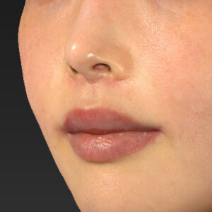 新宿ラクル美容外科クリニック　山本厚志　「人中短縮術（リップリフト）＋口角挙上（スマイルリップ）」　手術後３ヶ月目　４月２４日