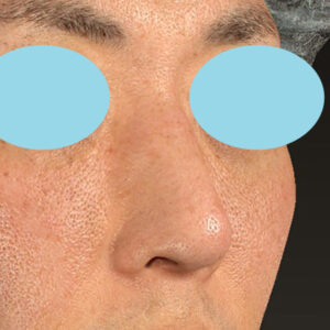 「ワシ鼻修正（ハンプ切除）」　新宿ラクル美容外科クリニック　４０代男性　手術後３ヶ月目　２月１０日