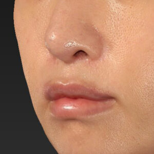 新宿ラクル美容外科クリニック　山本厚志　「外側人中短縮術（上口唇挙上術）修正 + 口角挙上（スマイルリフト）修正」　手術後３ヶ月目　２月１３日