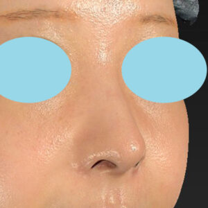 新宿ラクル美容外科クリニック　山本厚志　「小鼻縮小+α法」　手術後６ヶ月目　４月２日