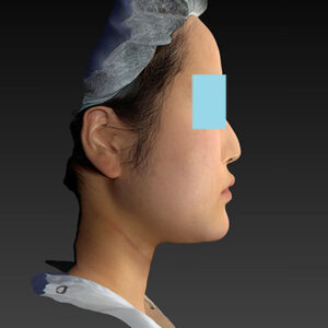 新宿ラクル美容外科クリニック　山本厚志　「ライポライフ脂肪吸引（メーラーファット+ジョールファット+アゴ下）」　手術後６ヶ月目　４月１５日