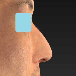 「ワシ鼻修正（ハンプ切除）」　新宿ラクル美容外科クリニック　４０代男性　手術前　１月１１日