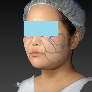 新宿ラクル美容外科クリニック　山本厚志　「ライポライフ脂肪吸引（メーラーファット+ジョールファット+アゴ下）」　デザイン　１月２７日