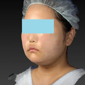 新宿ラクル美容外科クリニック　山本厚志　「ライポライフ脂肪吸引（メーラーファット+ジョールファット+アゴ下）」　手術直後　１月２７日