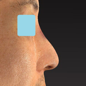 「ワシ鼻修正（ハンプ切除）」　新宿ラクル美容外科クリニック　４０代男性　手術直後　１月１１日