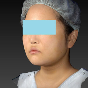 新宿ラクル美容外科クリニック　山本厚志　「ライポライフ脂肪吸引（メーラーファット+ジョールファット+アゴ下）」　手術後１週間目　１月２７日