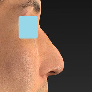 「ワシ鼻修正（ハンプ切除）」　新宿ラクル美容外科クリニック　４０代男性　手術後２週間目　１月１１日