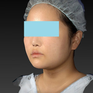 新宿ラクル美容外科クリニック　山本厚志　「ライポライフ脂肪吸引（メーラーファット+ジョールファット+アゴ下）」　手術後１ヶ月目　１月２７日