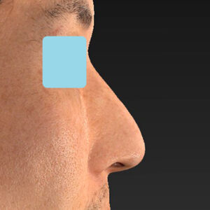 「ワシ鼻修正（ハンプ切除）」　新宿ラクル美容外科クリニック　４０代男性　手術後１ヶ月目　１月１１日