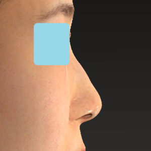 「鼻孔縁下降術」　新宿ラクル美容外科クリニック　山本厚志　３０代女性　手術後２ヶ月目　１月２３日