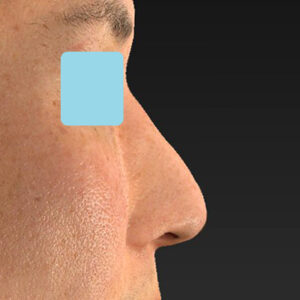 「ワシ鼻修正（ハンプ切除）」　新宿ラクル美容外科クリニック　４０代男性　手術後３ヶ月目　２月１０日