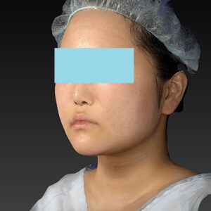 新宿ラクル美容外科クリニック　山本厚志　「ライポライフ脂肪吸引（メーラーファット+ジョールファット+アゴ下）」　手術後６ヶ月目　４月１５日