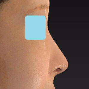 新宿ラクル美容外科クリニック　山本厚志　「小鼻縮小+α法」　手術後６ヶ月目　４月２日