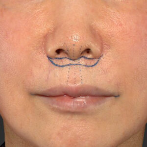 新宿ラクル美容外科クリニック　山本厚志　「人中短縮術（リップリフト）＋口角挙上（スマイルリップ）」　デザイン　２月６日