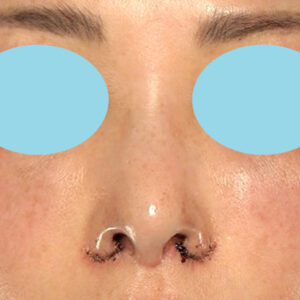 新宿ラクル美容外科クリニック　山本厚志　「小鼻縮小+α法 ＋ 鼻孔縁下降術」　手術直後　２月７日