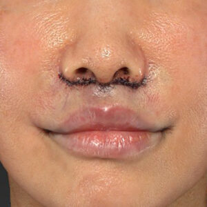 新宿ラクル美容外科クリニック　山本厚志　「人中短縮術（リップリフト）＋口角挙上（スマイルリップ）」　手術直後　２月６日