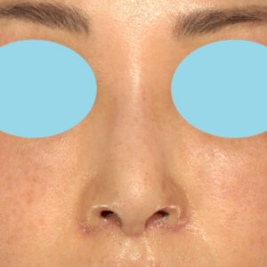 新宿ラクル美容外科クリニック　山本厚志　「小鼻縮小+α法 ＋ 鼻孔縁下降術」　手術後１週間目　２月７日